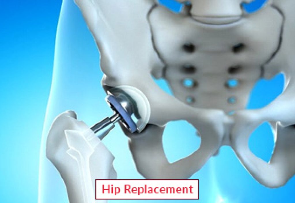 1681194806hip-replacement.jpg