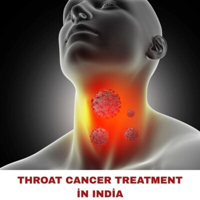 Throat Cancer Treatment in India (1).jpg