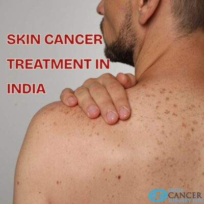 Skin Cancer Treatment in India.jpg